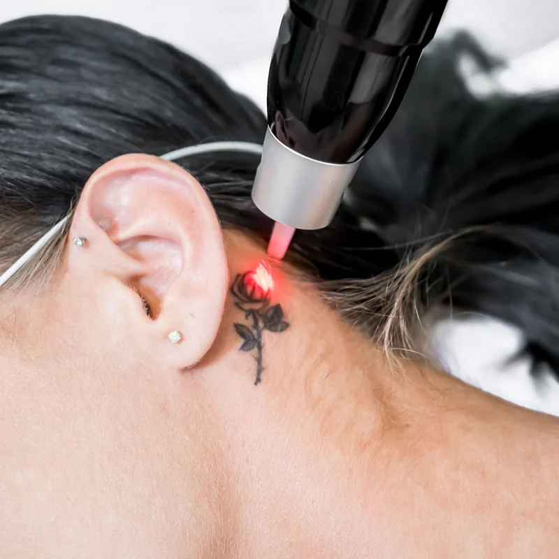 Woman getting a tattoo removed under her ear
